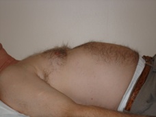 a diastasis