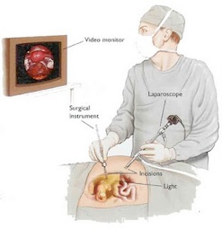 How long is the expected recovery time after hiatal hernia surgery?