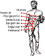 Positions of hernias in the body